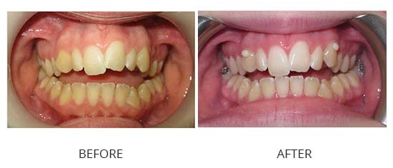 Case 3 - Anterior open bite (in progression)