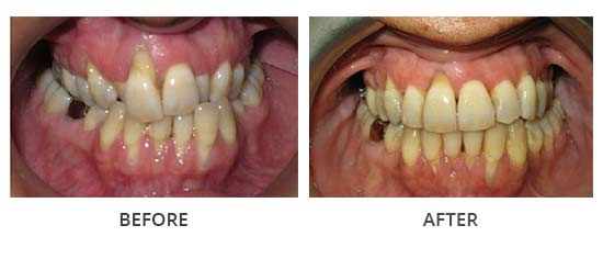 Case 5 – Severe crowding, narrow arches