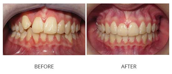 Case 4 - Severe crowding, instanding tooth