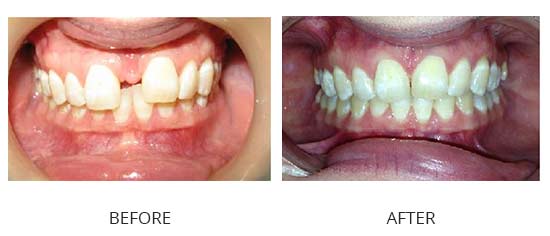 Case 2 - Large diastema